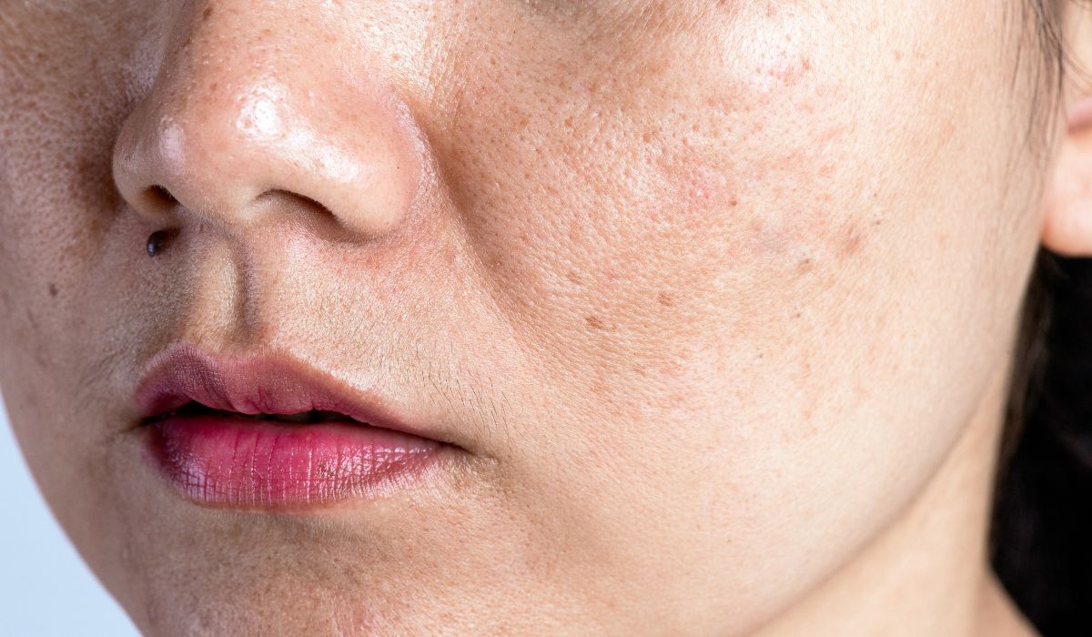 Penyebab Utama Flek Hitam di Wajah