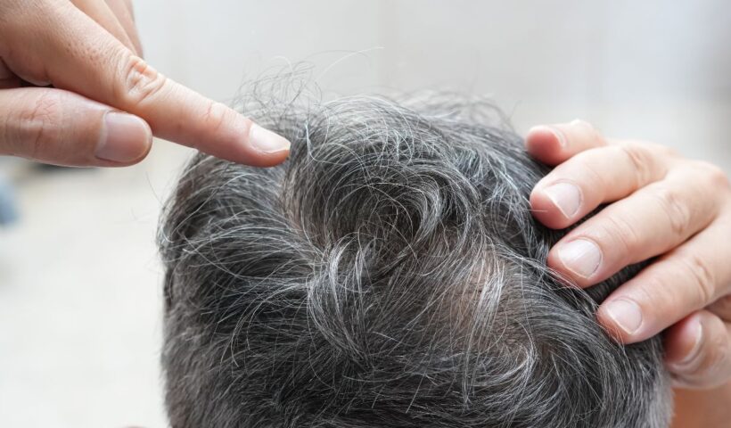 Rambut Uban: Usia Bukan Satu-Satunya Penyebab